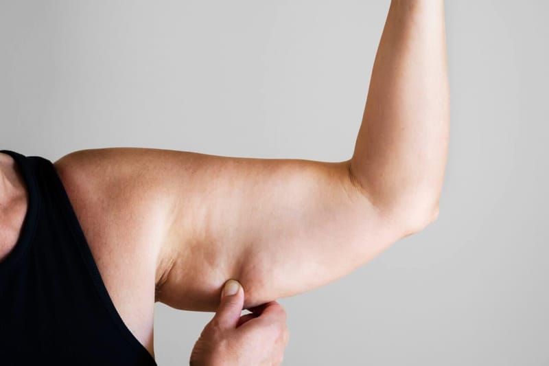 Lifting de braços: como funciona a cirurgia que elimina a flacidez dos braços