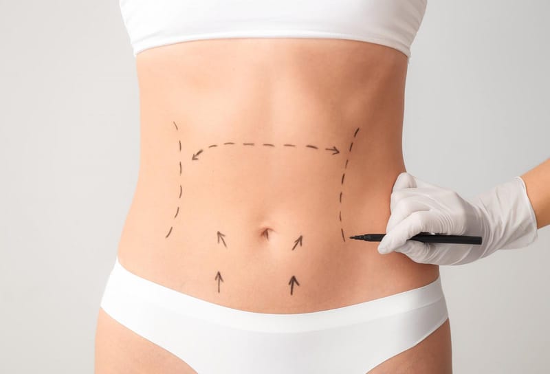 Saiba quanto custa uma abdominoplastia