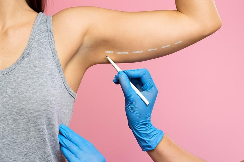 Lipo no Braço: a solução para a flacidez e acúmulo de gordura