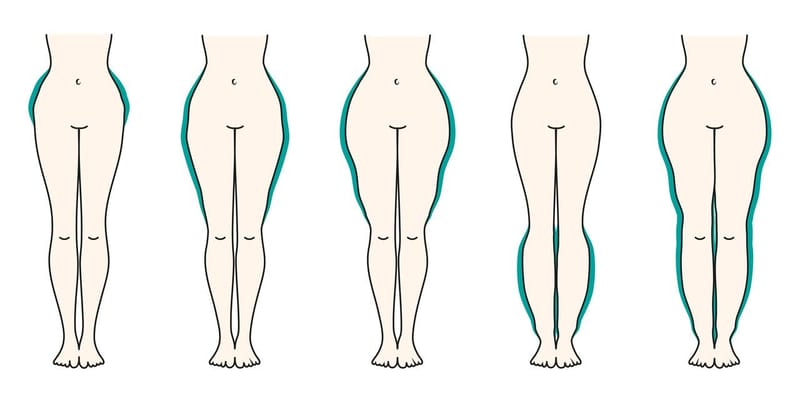 Gordura de lipedema: diferenças da obesidade e formas de tratamento