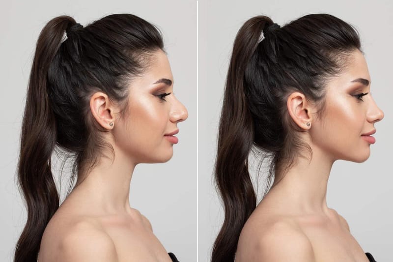 Perfiloplastia: o que é e como o procedimento harmoniza o rosto