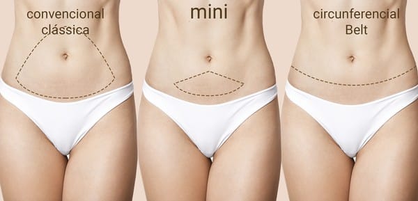 Tudo o que você sempre quis saber sobre abdominoplastia